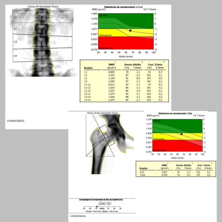 Densitometria Óssea O Que é E Para Que Serve Ecocenter Diagnósticos Por Imagem 9731